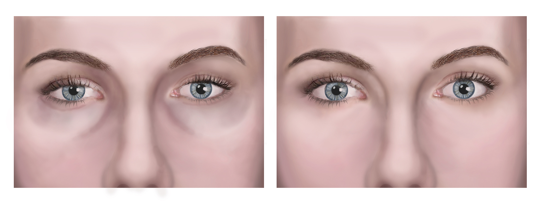 Ssurvivor Malar Bags After Filler